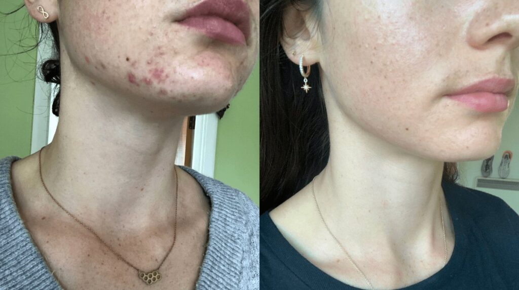 Breakouts Have Entered the Chat: OLEHENRIKSEN Acne Care Gets Down to Business